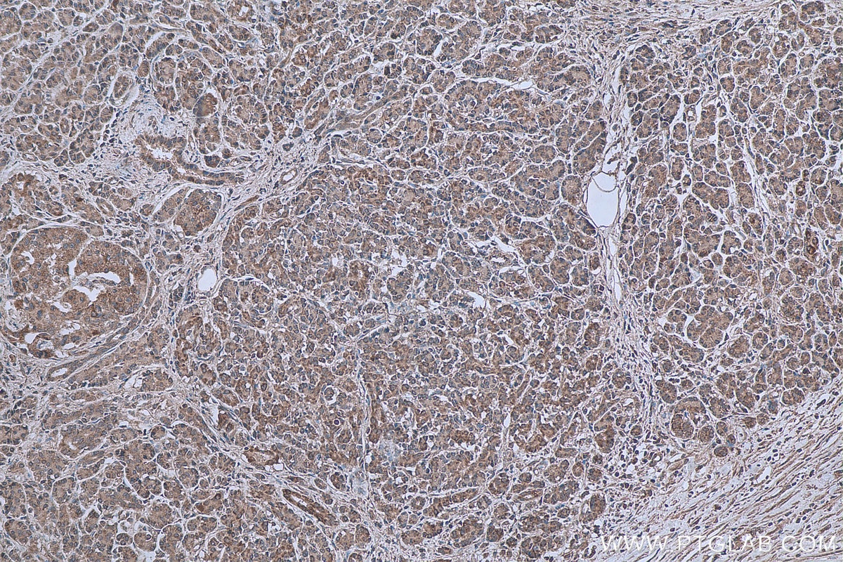 Immunohistochemical analysis of paraffin-embedded human pancreas cancer tissue slide using KHC0620 (cIAP1 IHC Kit).