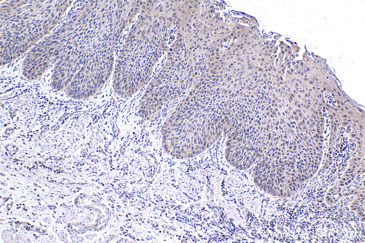 Immunohistochemical analysis of paraffin-embedded human oesophagus cancer tissue slide using KHC1421 (BMAL1/ARNTL IHC Kit).