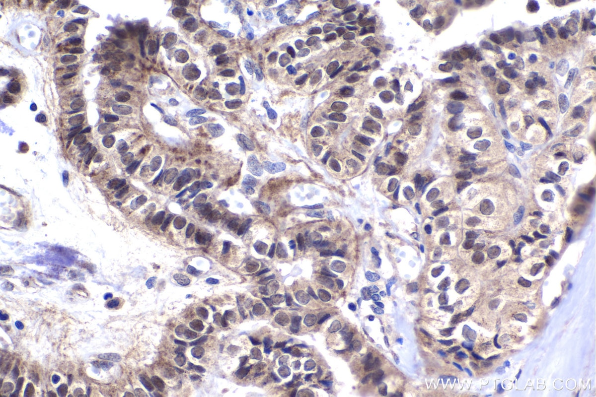 Immunohistochemical analysis of paraffin-embedded human thyroid cancer tissue slide using KHC1421 (BMAL1/ARNTL IHC Kit).