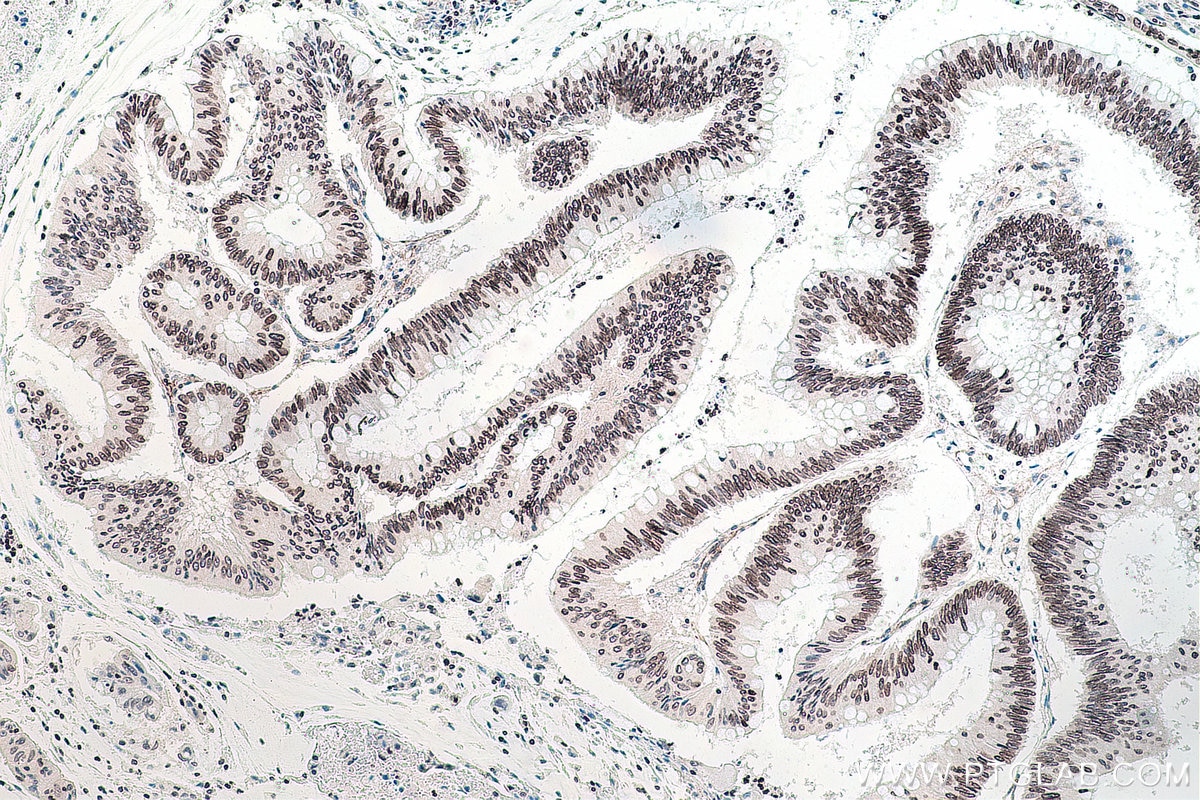 Immunohistochemical analysis of paraffin-embedded human colon cancer tissue slide using KHC0296 (BMI1 IHC Kit).