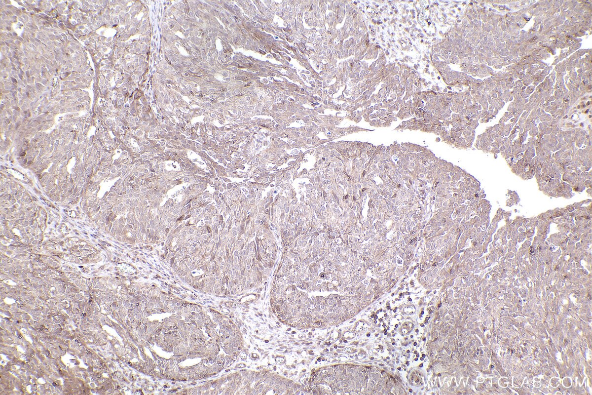 Immunohistochemical analysis of paraffin-embedded human ovary cancer tissue slide using KHC2413 (BNIP2 IHC Kit).