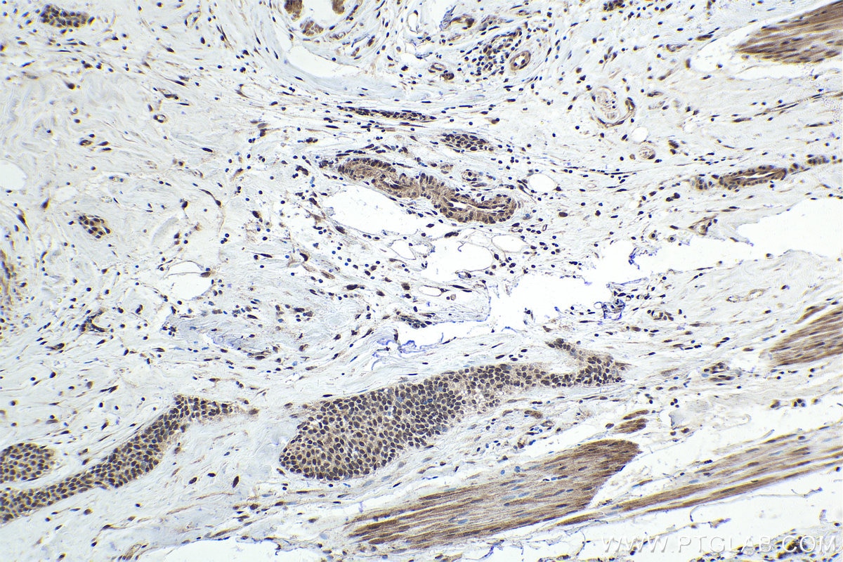 Immunohistochemical analysis of paraffin-embedded human urothelial carcinoma tissue slide using KHC1692 (BPTF IHC Kit).