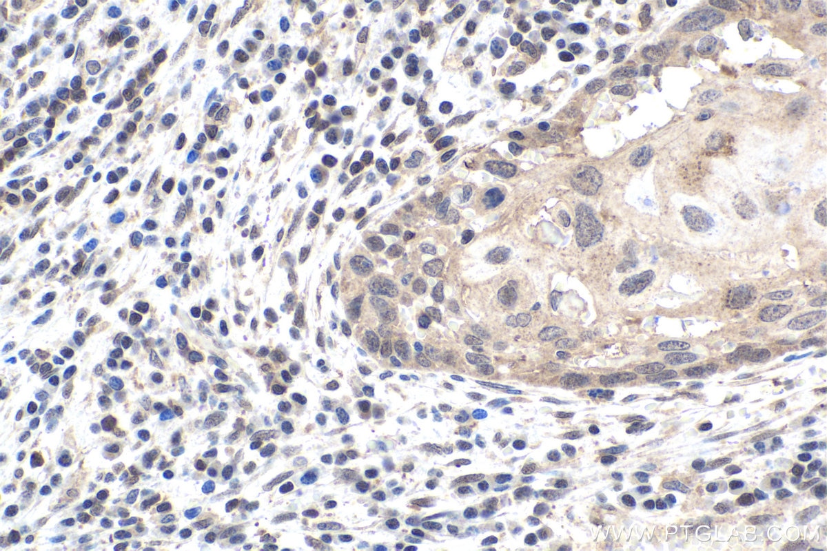 Immunohistochemical analysis of paraffin-embedded human cervical cancer tissue slide using KHC1955 (BRD7 IHC Kit).