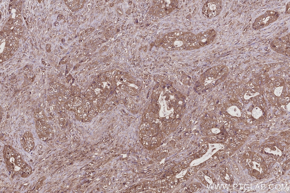 Immunohistochemical analysis of paraffin-embedded human pancreas cancer tissue slide using KHC2970 (BRE IHC Kit).