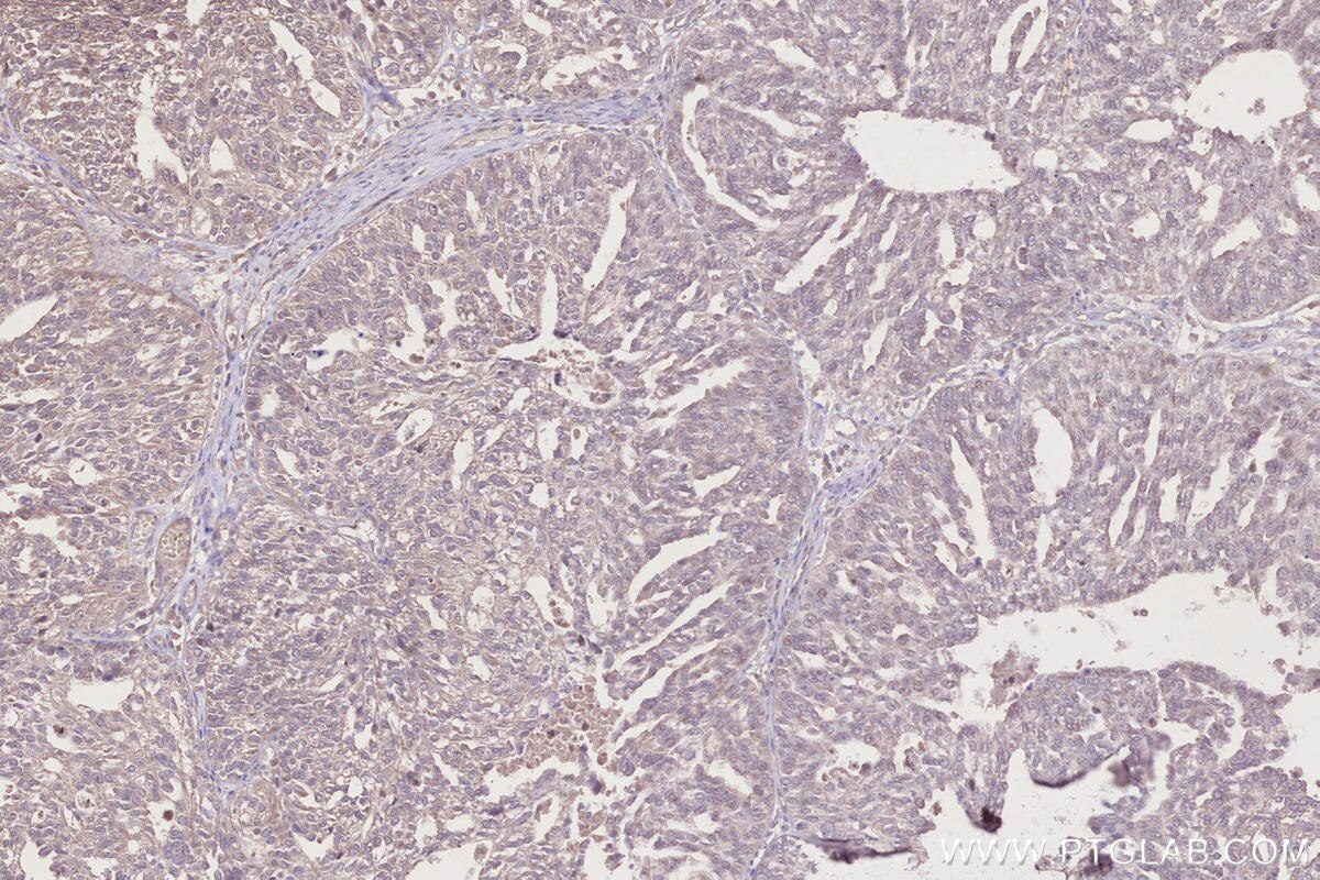 Immunohistochemical analysis of paraffin-embedded human ovary cancer tissue slide using KHC2733 (BRK1/C3orf10 IHC Kit).