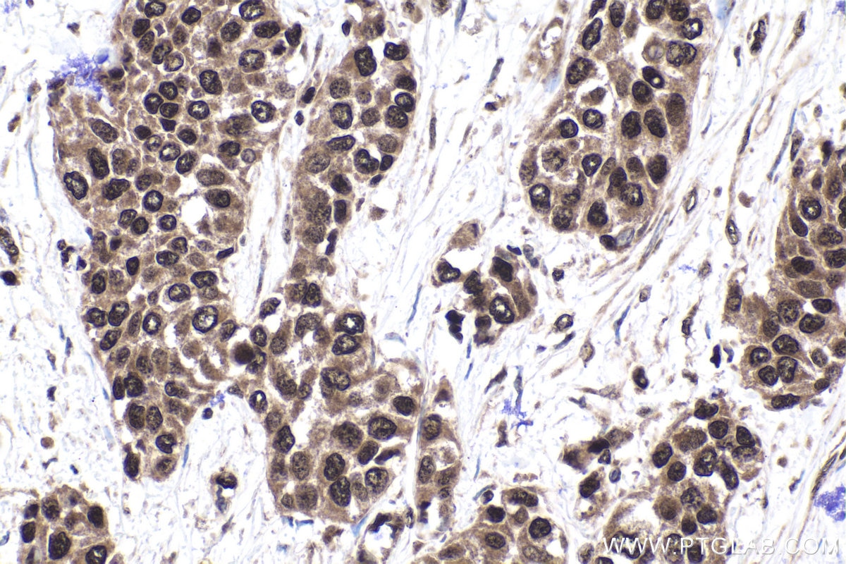 Immunohistochemical analysis of paraffin-embedded human urothelial carcinoma tissue slide using KHC1949 (BRMS1 IHC Kit).