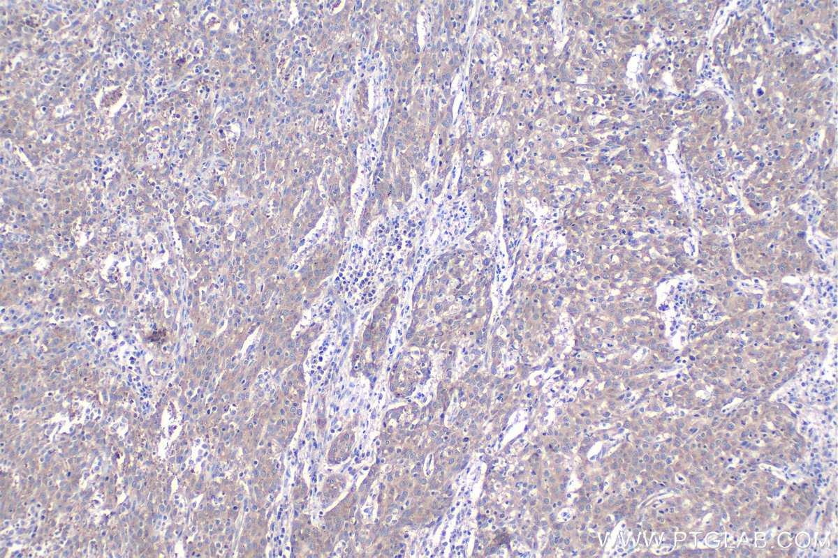 Immunohistochemical analysis of paraffin-embedded human cervical cancer tissue slide using KHC1009 (BTF3L4 IHC Kit).