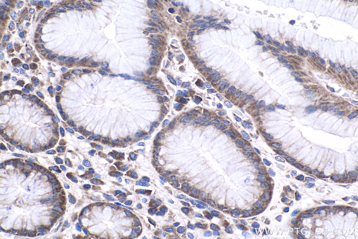 Immunohistochemical analysis of paraffin-embedded human stomach cancer tissue slide using KHC1009 (BTF3L4 IHC Kit).