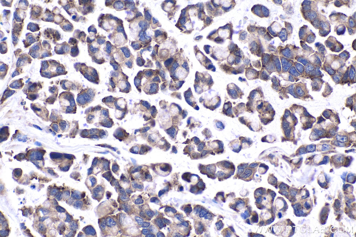 Immunohistochemical analysis of paraffin-embedded human colon cancer tissue slide using KHC1009 (BTF3L4 IHC Kit).