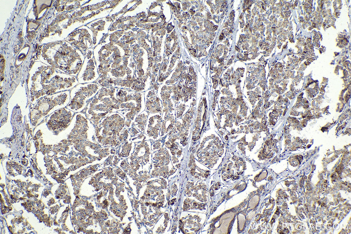 Immunohistochemical analysis of paraffin-embedded human thyroid cancer tissue slide using KHC2013 (BTRC IHC Kit).