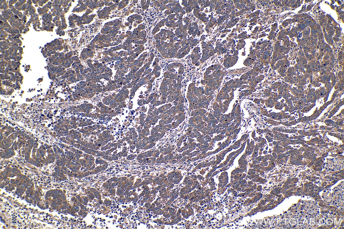 Immunohistochemical analysis of paraffin-embedded human ovary tumor tissue slide using KHC1358 (BYSL IHC Kit).