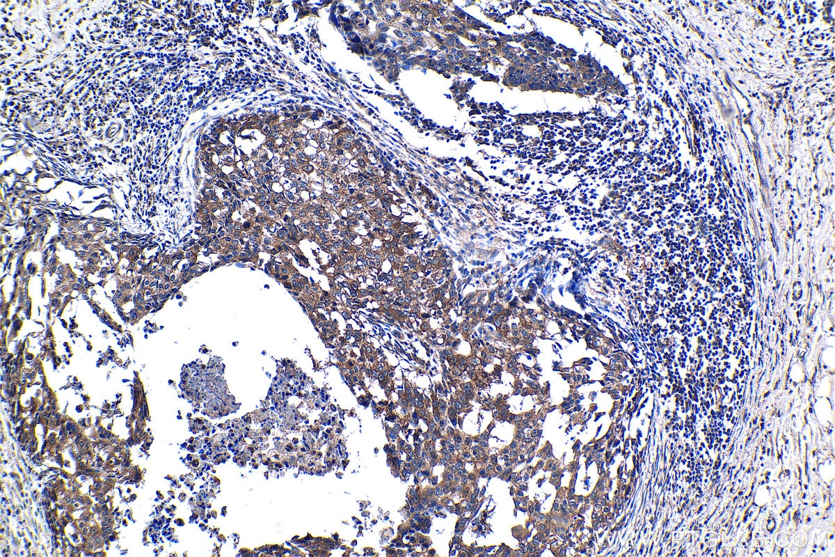 Immunohistochemical analysis of paraffin-embedded human breast cancer tissue slide using KHC1358 (BYSL IHC Kit).