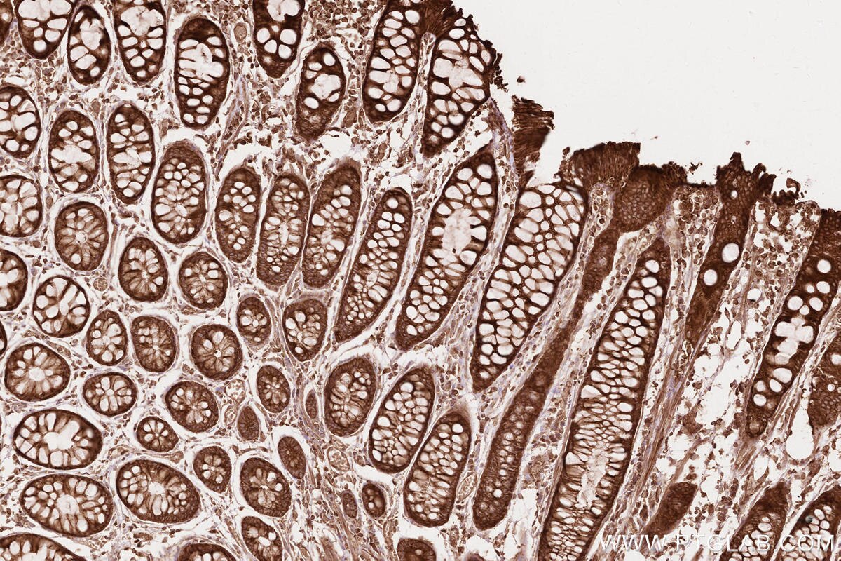 Immunohistochemical analysis of paraffin-embedded human rectal cancer tissue slide using KHC2612 (BZW1 IHC Kit).