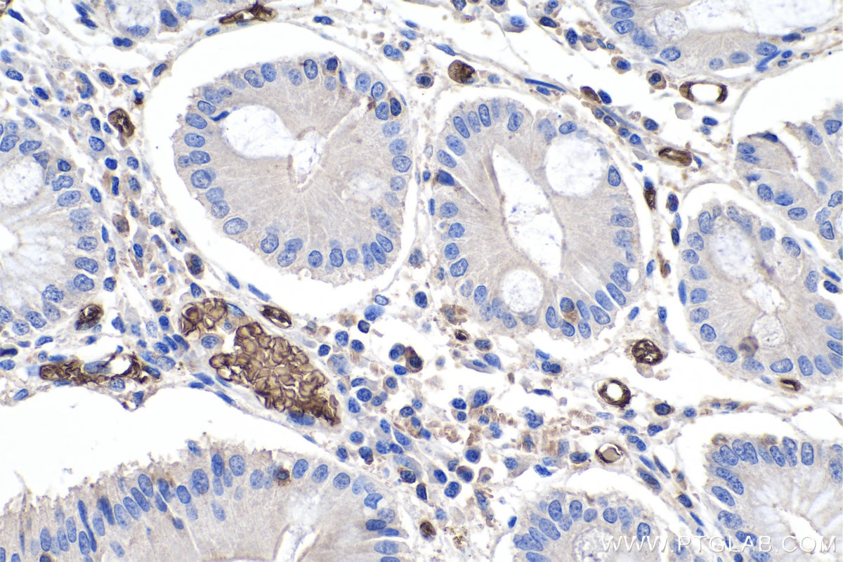 Immunohistochemical analysis of paraffin-embedded human stomach cancer tissue slide using KHC0200 (band 3/ AE1 IHC Kit).
