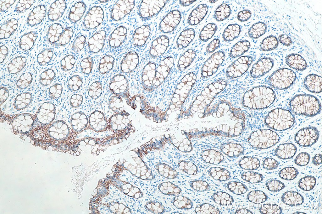 Immunohistochemical analysis of paraffin-embedded human colon tissue slide using KHC0008 (Beta Catenin IHC Kit)