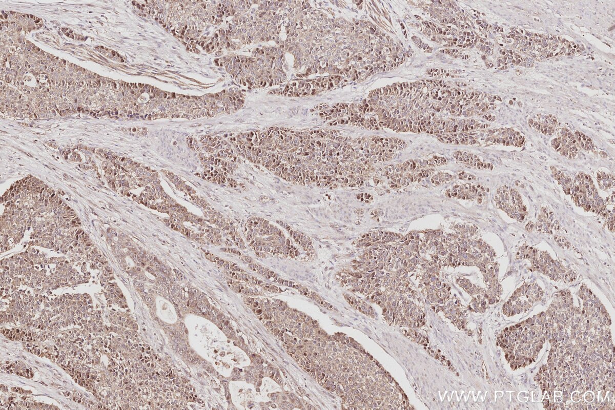 Immunohistochemical analysis of paraffin-embedded human stomach cancer tissue slide using KHC3070 (C15orf23 IHC Kit). Immunohistochemical analysis of paraffin-embedded human stomach cancer tissue slide using KHC3070 (C15orf23 IHC Kit).