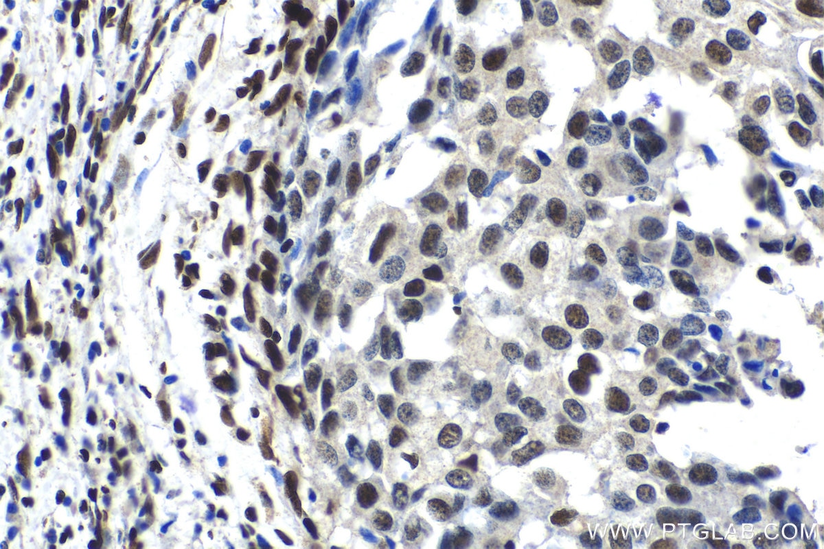 Immunohistochemical analysis of paraffin-embedded human breast cancer tissue slide using KHC1412 (C17orf49 IHC Kit).
