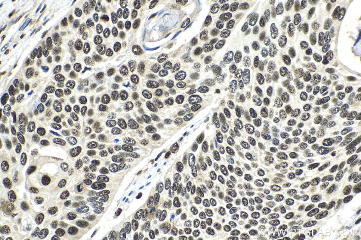 Immunohistochemical analysis of paraffin-embedded human oesophagus cancer tissue slide using KHC1412 (C17orf49 IHC Kit).