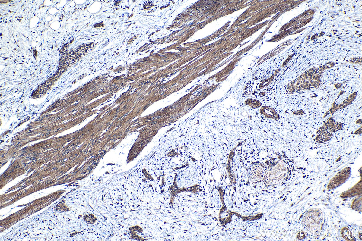 Immunohistochemical analysis of paraffin-embedded human urothelial carcinoma tissue slide using KHC1295 (C18orf21 IHC Kit).