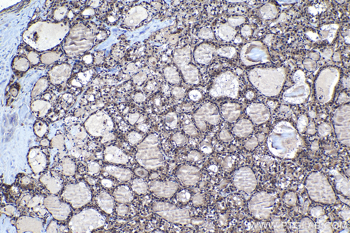 Immunohistochemical analysis of paraffin-embedded human thyroid cancer tissue slide using KHC1295 (C18orf21 IHC Kit).