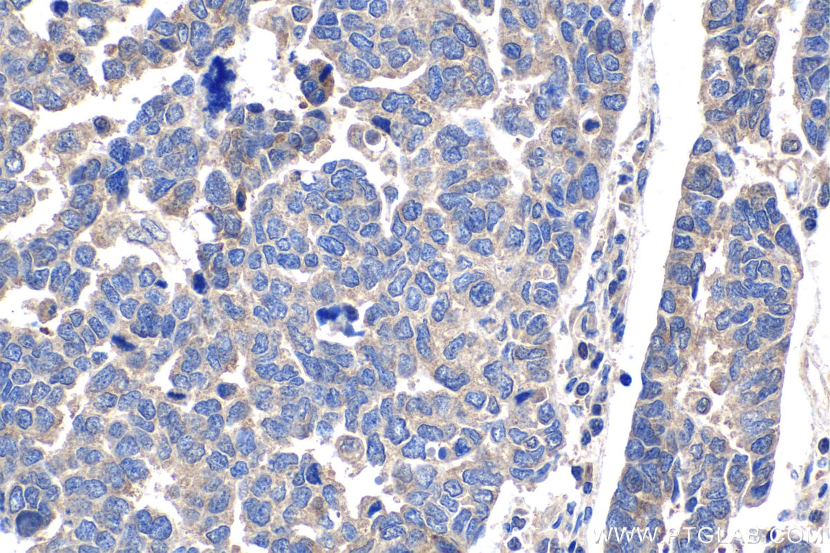 Immunohistochemical analysis of paraffin-embedded human ovary tumor tissue slide using KHC1480 (C19orf2 IHC Kit).