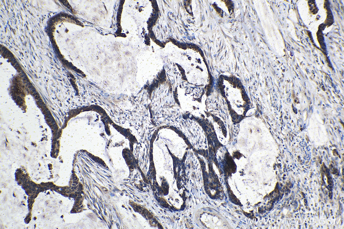 Immunohistochemical analysis of paraffin-embedded human urothelial carcinoma tissue slide using KHC1480 (C19orf2 IHC Kit).