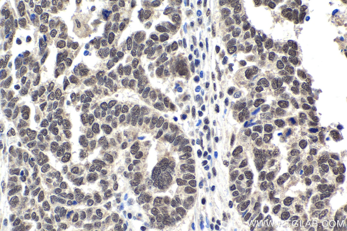 Immunohistochemical analysis of paraffin-embedded human ovary tumor tissue slide using KHC1722 (C1D IHC Kit).