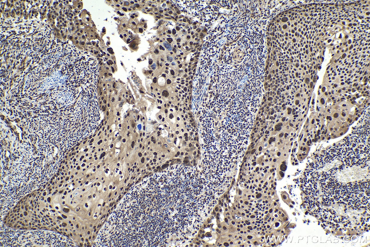Immunohistochemical analysis of paraffin-embedded human cervical cancer tissue slide using KHC1722 (C1D IHC Kit).