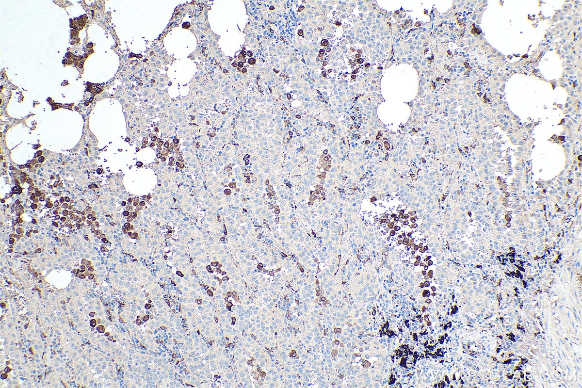 Immunohistochemical analysis of paraffin-embedded human lung cancer tissue slide using KHC0479 (C1QA IHC Kit).