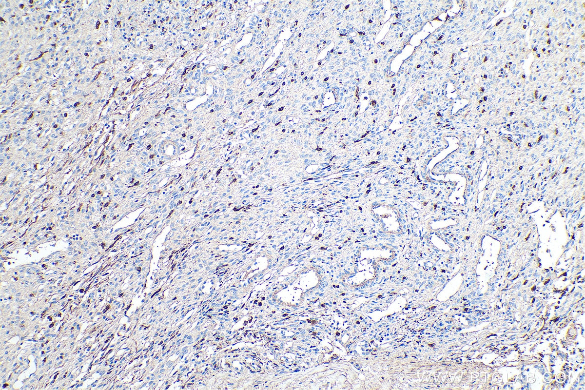 Immunohistochemical analysis of paraffin-embedded human ovary tumor tissue slide using KHC0479 (C1QA IHC Kit).
