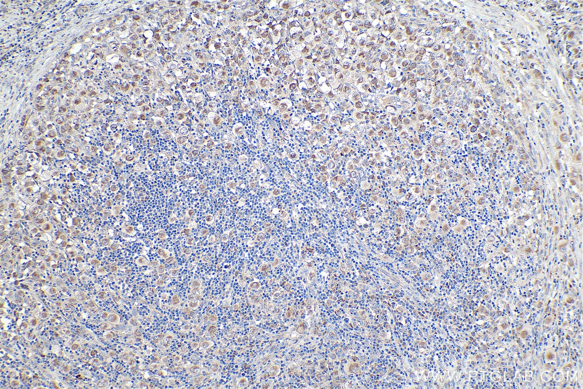 Immunohistochemical analysis of paraffin-embedded human lymphoma tissue slide using KHC0372 (C1QC IHC Kit).