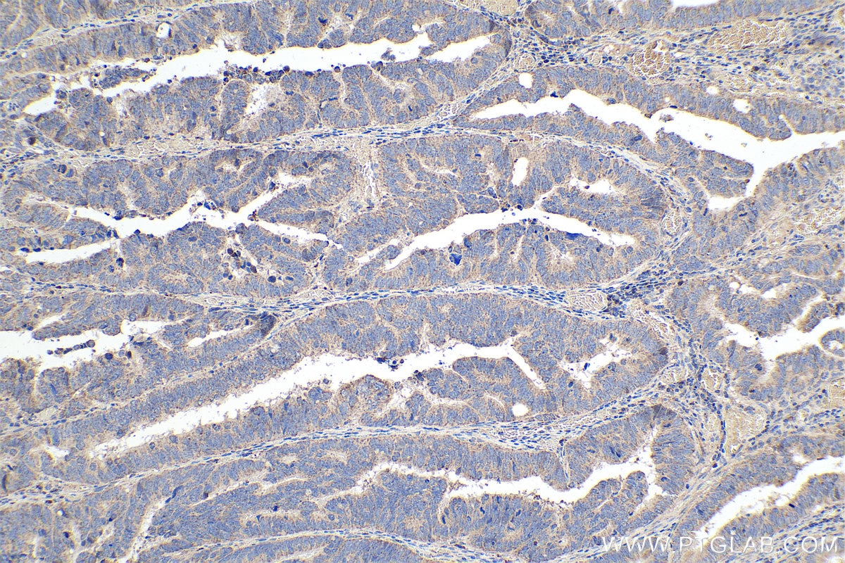 Immunohistochemical analysis of paraffin-embedded human colon cancer tissue slide using KHC0372 (C1QC IHC Kit).