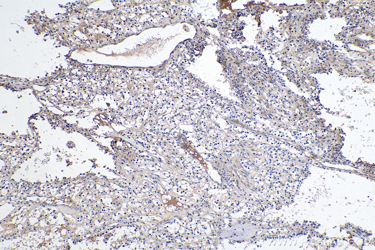 Immunohistochemical analysis of paraffin-embedded human renal cell carcinoma tissue slide using KHC0404 (C1R IHC Kit).
