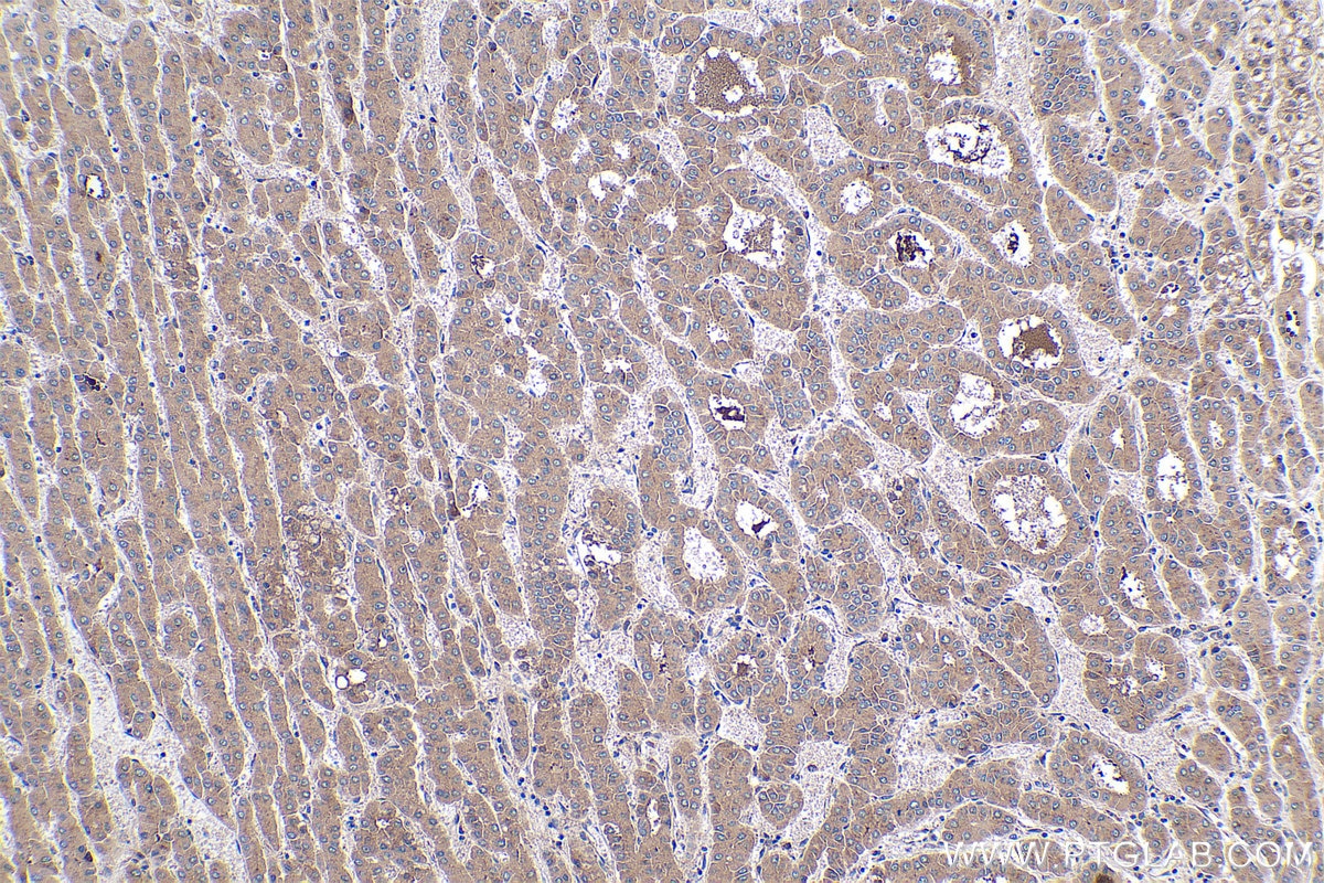 Immunohistochemical analysis of paraffin-embedded human liver cancer tissue slide using KHC0404 (C1R IHC Kit).