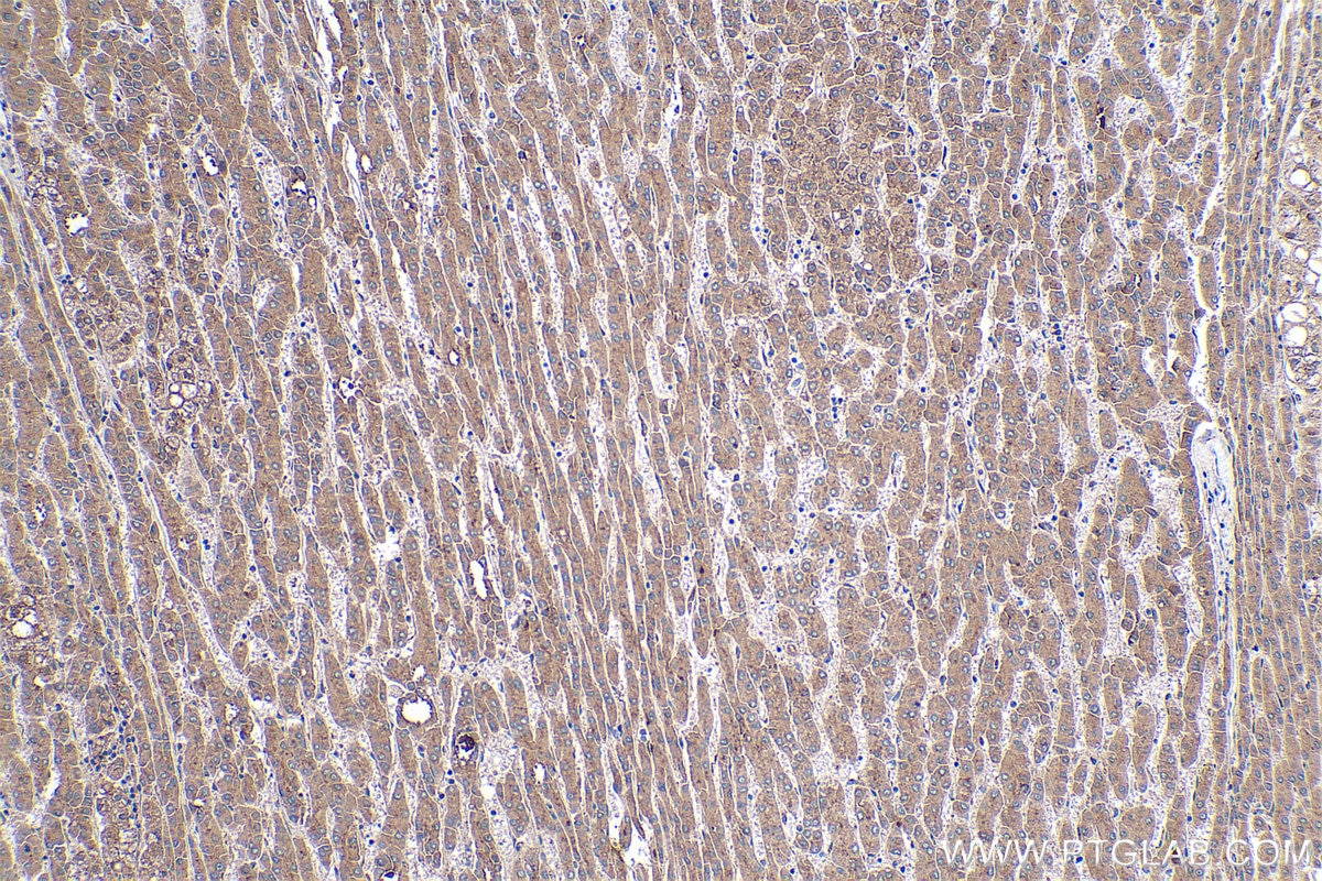 Immunohistochemical analysis of paraffin-embedded human liver cancer tissue slide using KHC0405 (C1S IHC Kit).