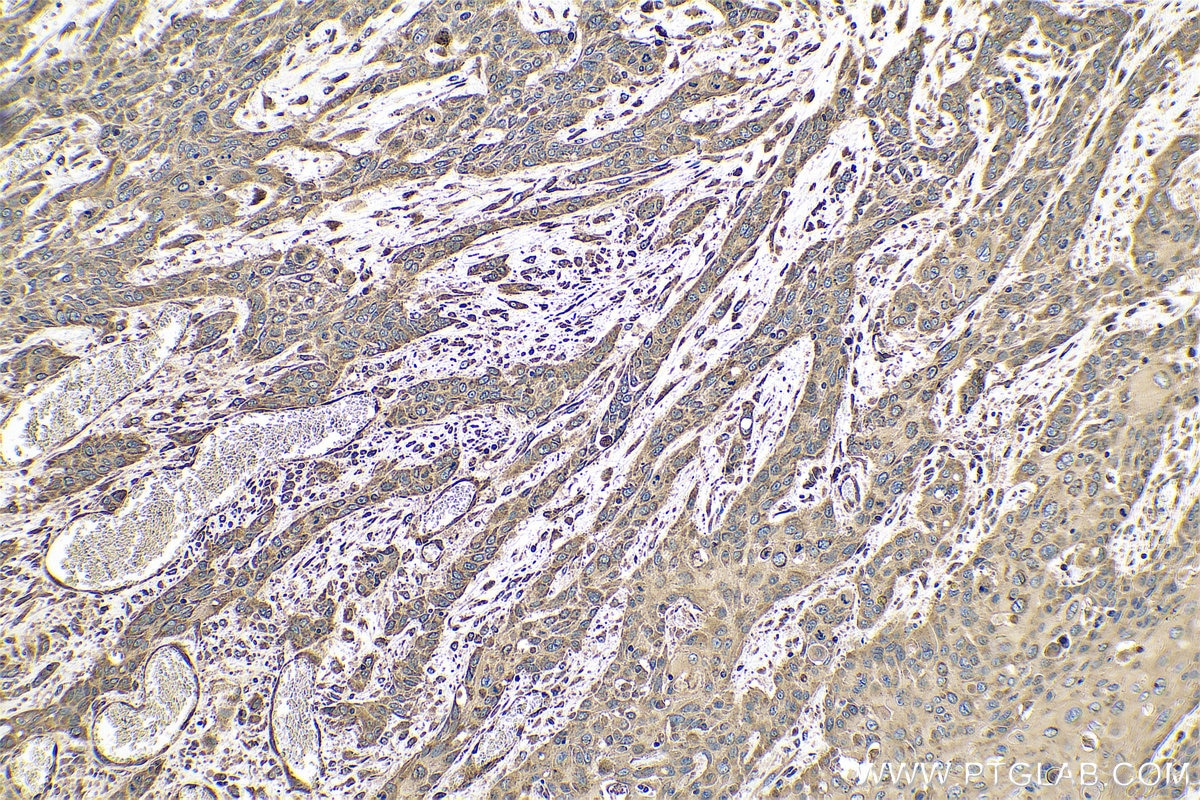 Immunohistochemical analysis of paraffin-embedded human oesophagus cancer tissue slide using KHC0599 (SLC52A3 IHC Kit).