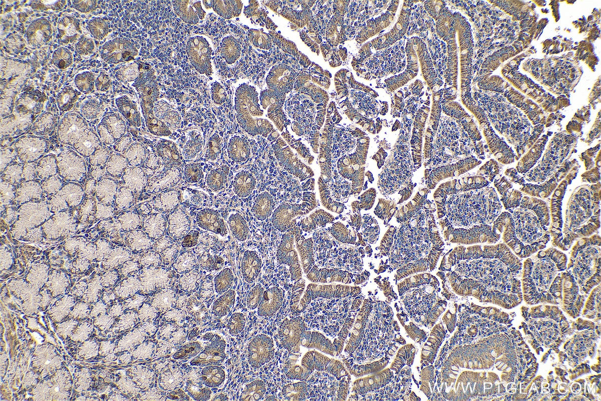 Immunohistochemical analysis of paraffin-embedded human stomach cancer tissue slide using KHC0599 (SLC52A3 IHC Kit).