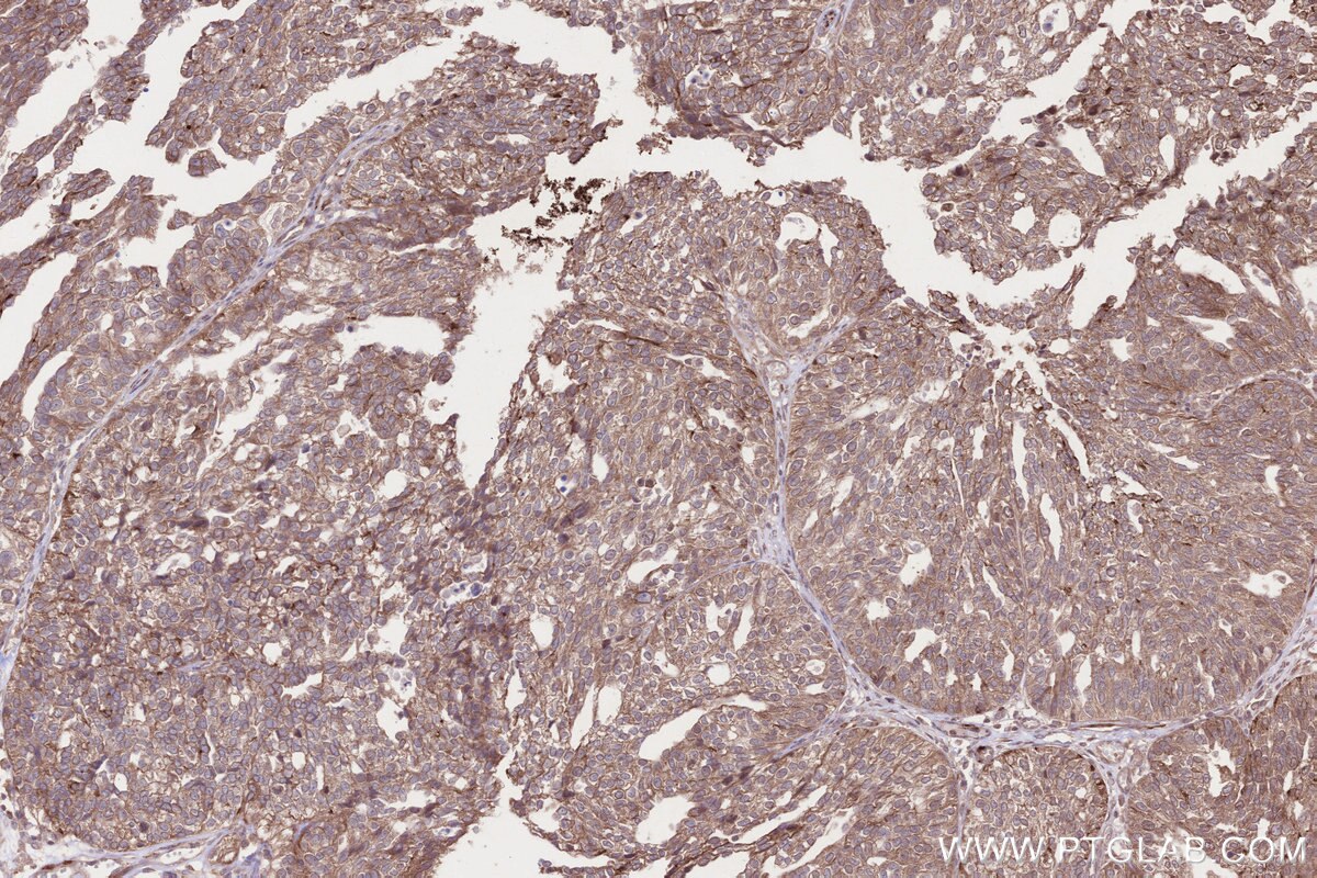 Immunohistochemical analysis of paraffin-embedded human ovary cancer tissue slide using KHC2641 (C2CD5 IHC Kit).