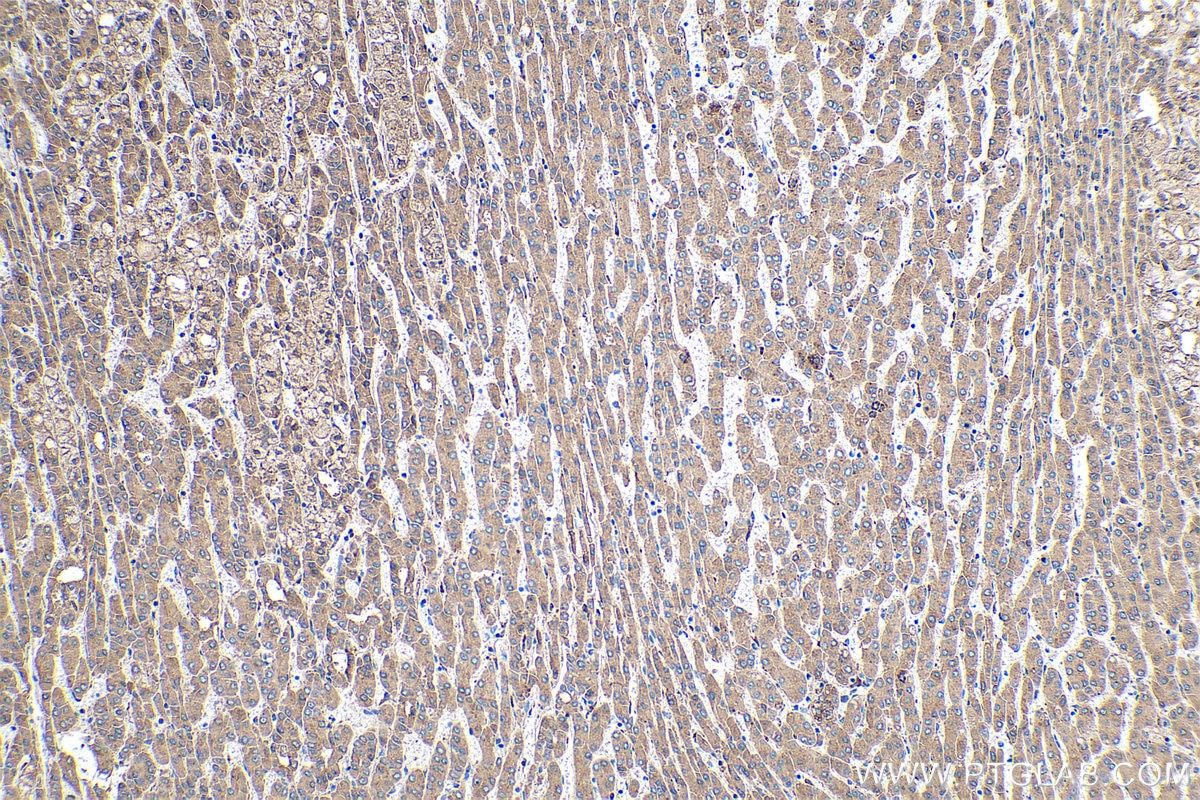 Immunohistochemical analysis of paraffin-embedded human liver cancer tissue slide using KHC0375 (C3 IHC Kit).