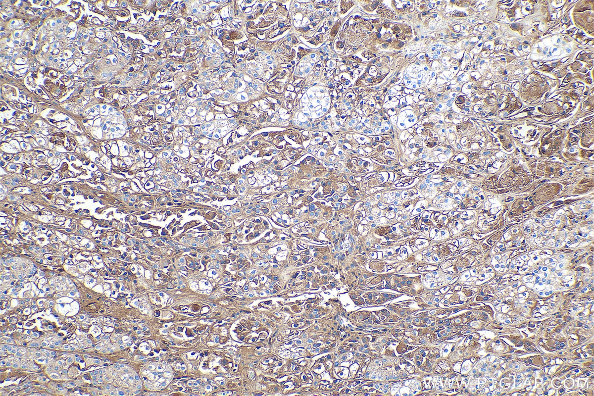 Immunohistochemical analysis of paraffin-embedded human endometrial cancer tissue slide using KHC0375 (C3 IHC Kit).