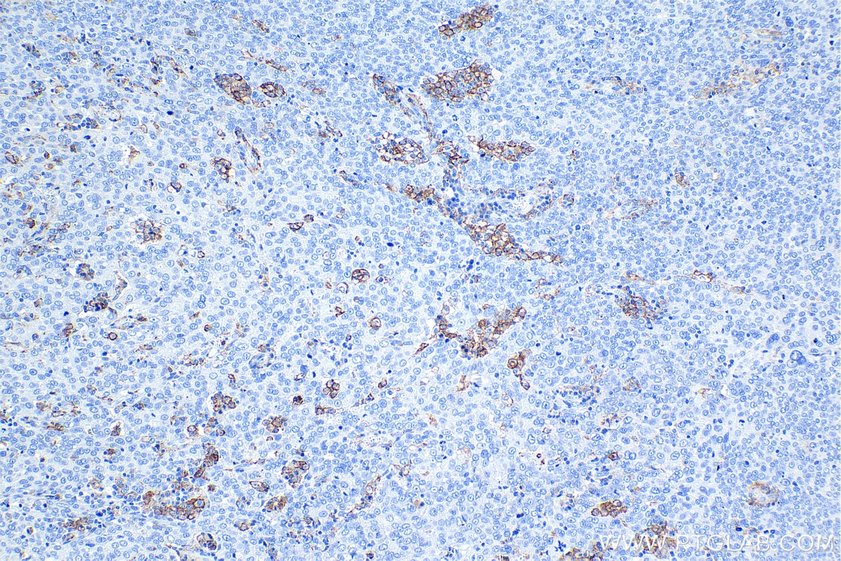 Immunohistochemical analysis of paraffin-embedded human ovary tumor tissue slide using KHC1293 (C5AR1 IHC Kit).