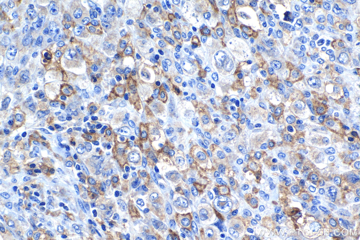 Immunohistochemical analysis of paraffin-embedded human lymphoma tissue slide using KHC1293 (C5AR1 IHC Kit).