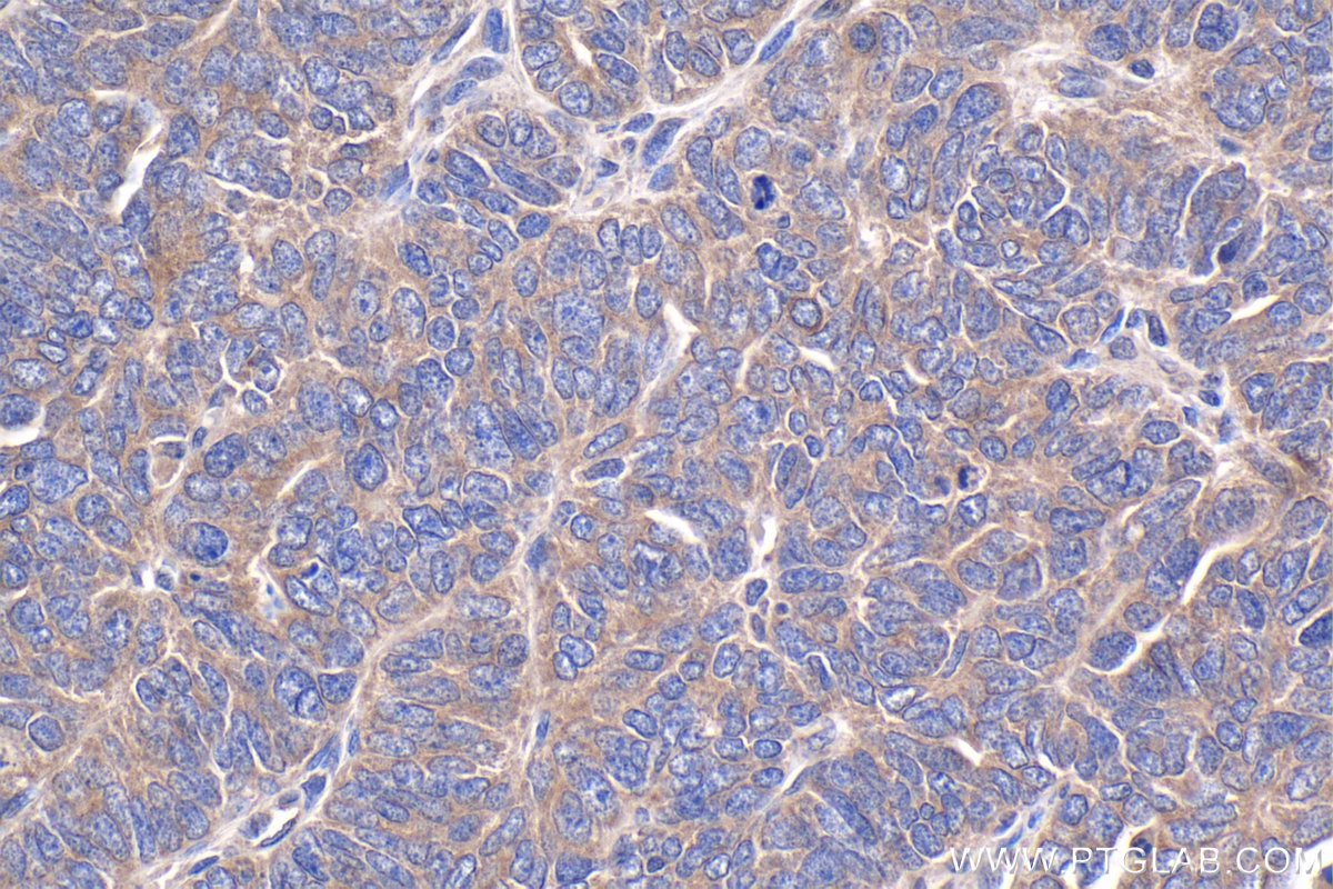 Immunohistochemical analysis of paraffin-embedded human ovary tumor tissue slide using KHC1878 (C9orf72 IHC Kit).