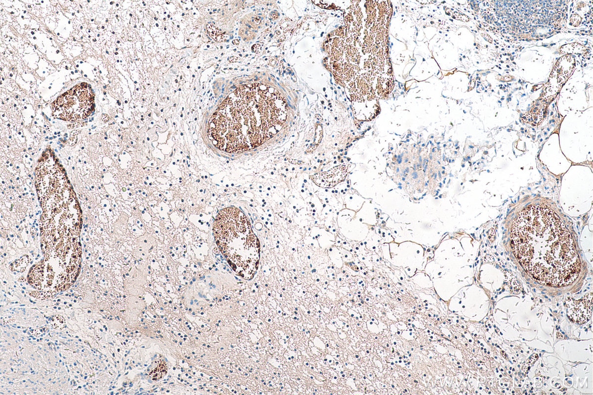 Immunohistochemical analysis of paraffin-embedded human appendicitis tissue slide using KHC0551 (CA1 IHC Kit).