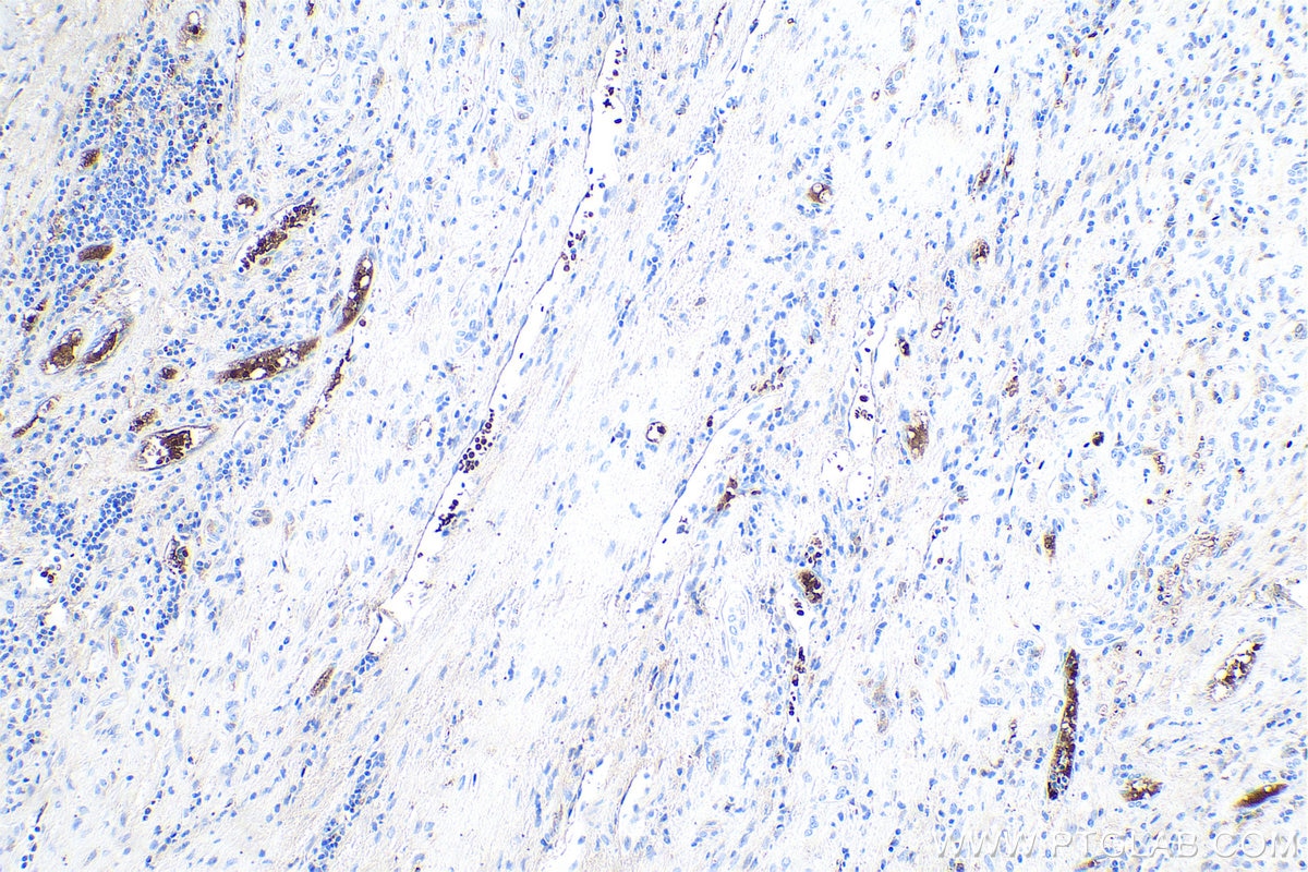 Immunohistochemical analysis of paraffin-embedded human liver cancer tissue slide using KHC0551 (CA1 IHC Kit).