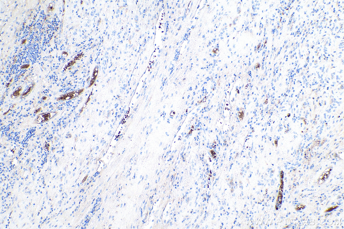 Immunohistochemical analysis of paraffin-embedded human liver cancer tissue slide using KHC0551 (CA1 IHC Kit).