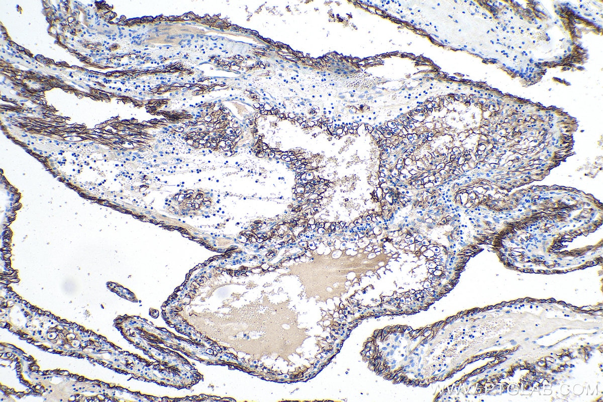 Immunohistochemical analysis of paraffin-embedded human renal cell carcinoma tissue slide using KHC0187 (CA9 IHC Kit).