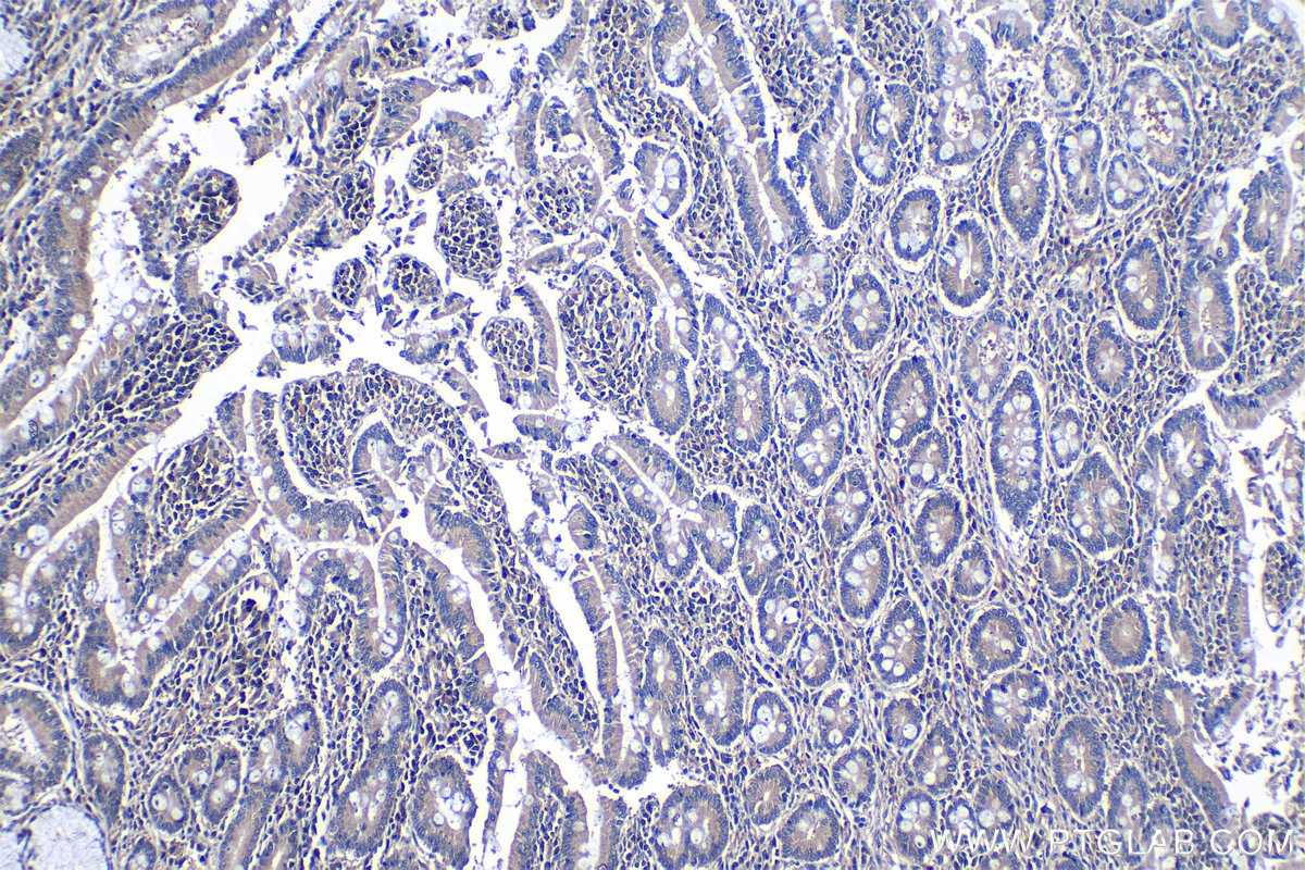 Immunohistochemical analysis of paraffin-embedded human stomach cancer tissue slide using KHC1271 (CAB39L IHC Kit).