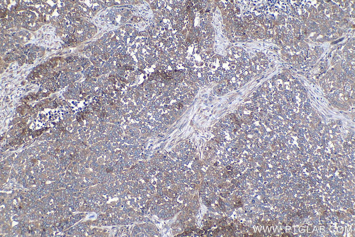Immunohistochemical analysis of paraffin-embedded human ovary tumor tissue slide using KHC1271 (CAB39L IHC Kit).