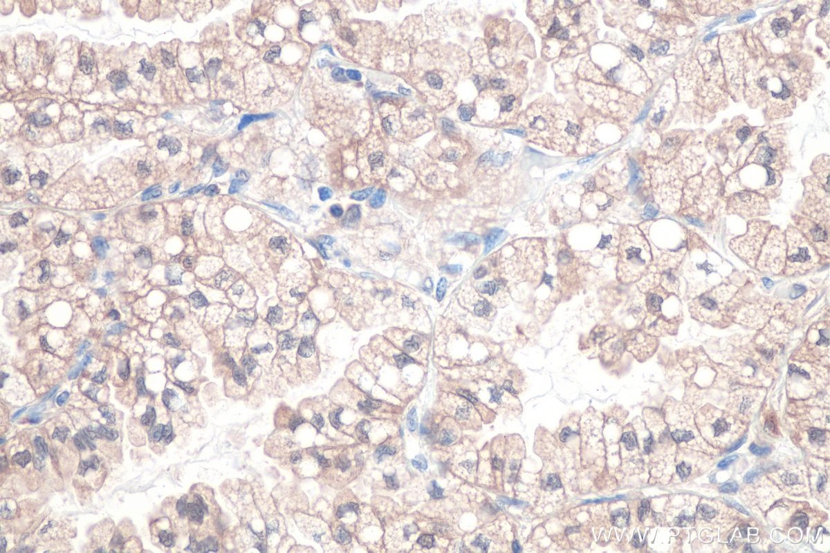 Immunohistochemical analysis of paraffin-embedded human lung cancer tissue slide using KHC0868 (CACYBP IHC Kit).